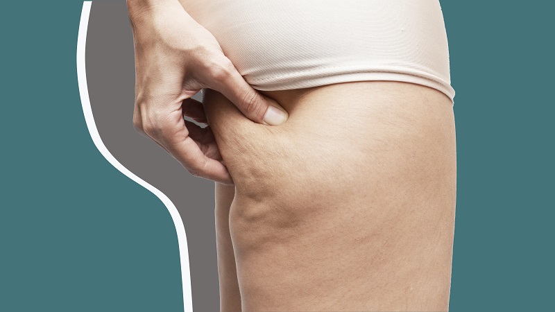 la cellulite