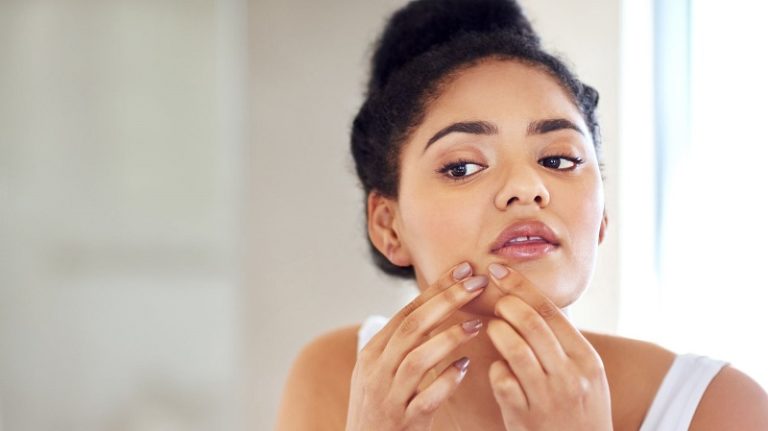 4 Soins naturels anti acné aux huiles essentielles