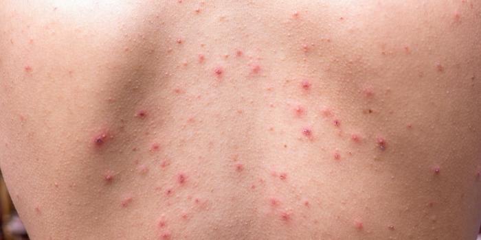 Comment se débarrasser de l’acné sur le dos et du visage