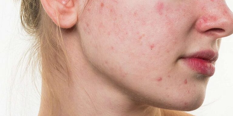 Son remède 100% naturel pour se débarrasser de l’acné est un miracle