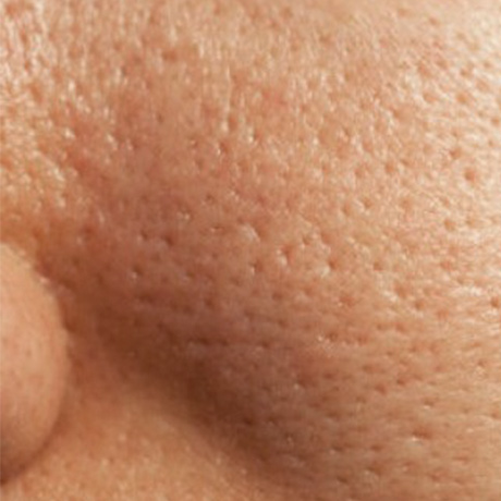 Pores dilatés : causes et traitements