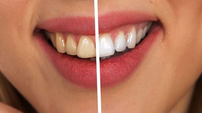 6757AE97-160B-4AC7-9155-145AC1128BE3 blanchir ses dents