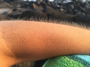 Comment se débarrasser de la chair de poule sur les mains