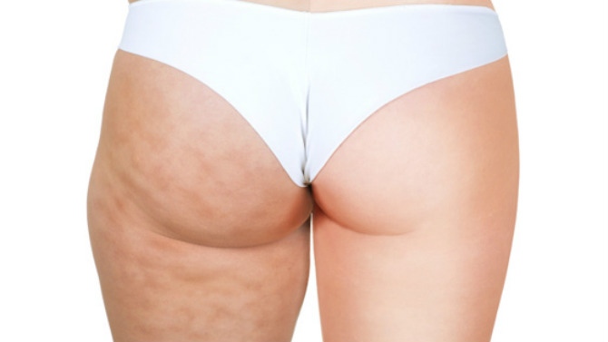 Éliminer la cellulite avec ces remèdes maison
