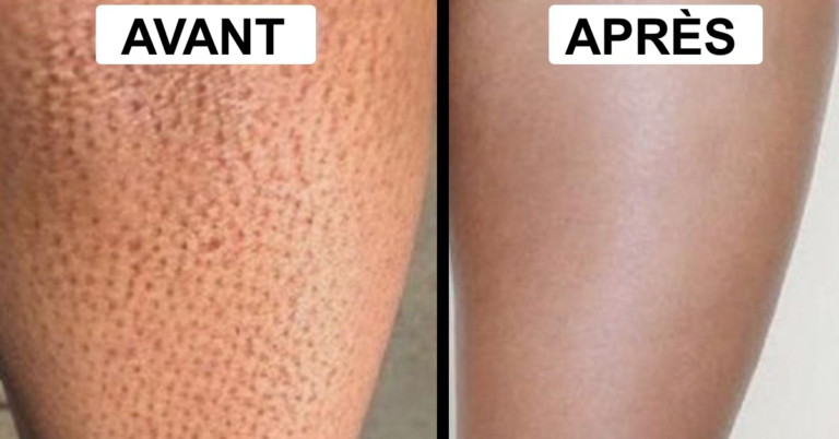 Comment se débarrasser de la chair de poule sur les mains ?