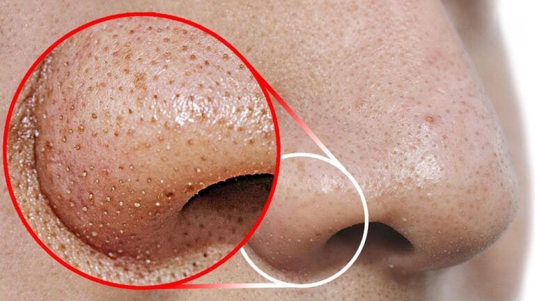Points noirs et pores dilatés : conseils