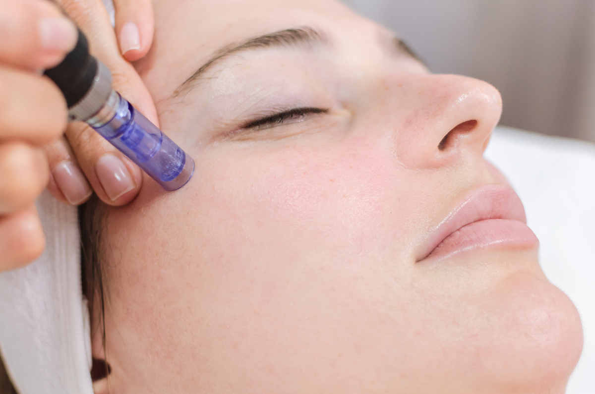 microneedling microneedling