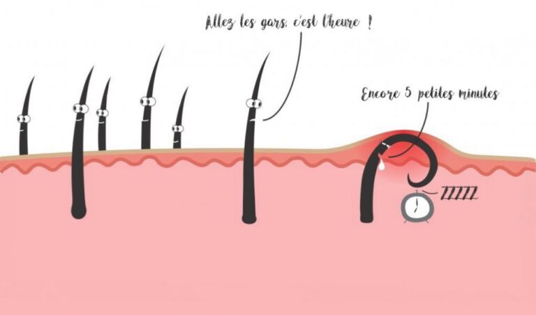 Des solutions naturelles pour éradiquer et prévenir les poils incarnés.
