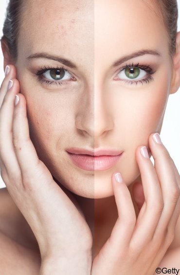 Comment atténuer les taches brunes sur le visage  ?