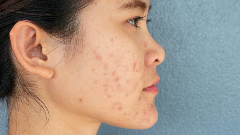 Cicatrices d’acné : comment retrouver une belle peau