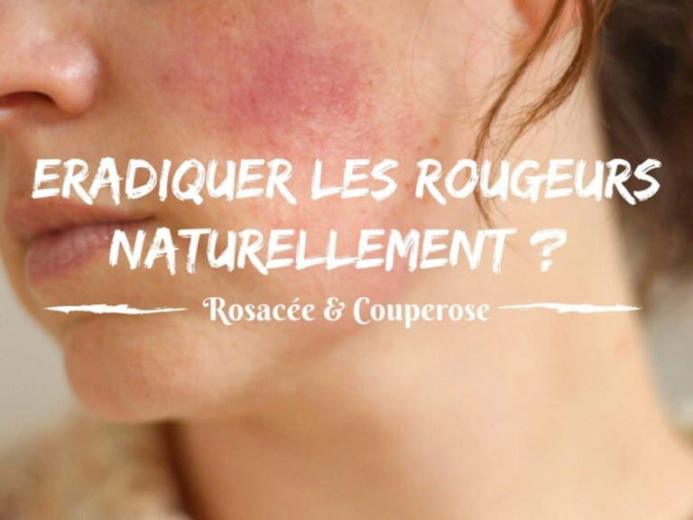 Comment traiter naturellement les rougeurs ? (rosacée & couperose)
