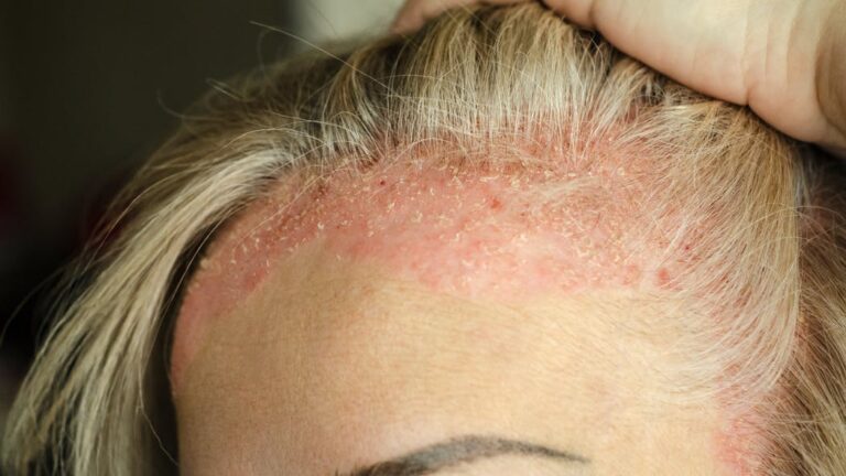 Psoriasis du cuir chevelu : comment réduire les crises  ?