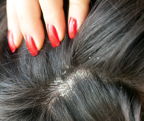 LE PSORIASIS DU CUIR CHEVELU