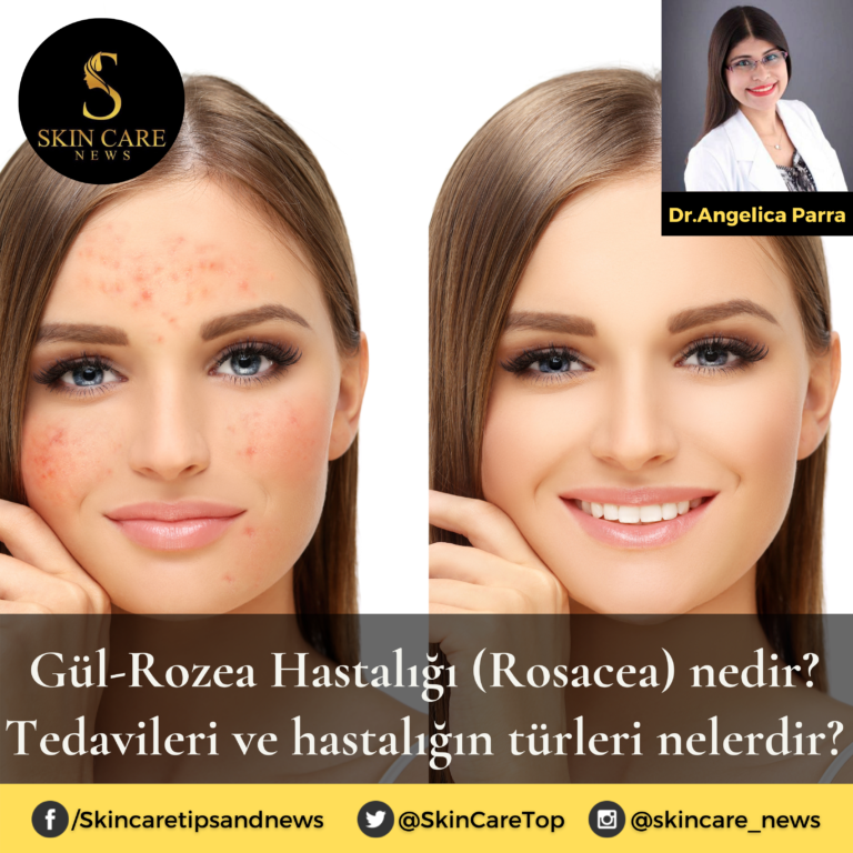Gül-Rozea Hastalığı (Rosacea) nedir? Tedavileri ve hastalığın türleri nelerdir?