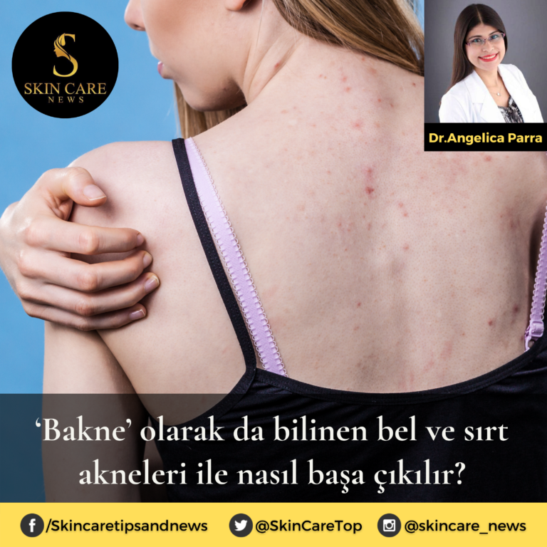 ‘Bakne’ olarak da bilinen bel ve sırt akneleri ile nasıl başa çıkılır?
