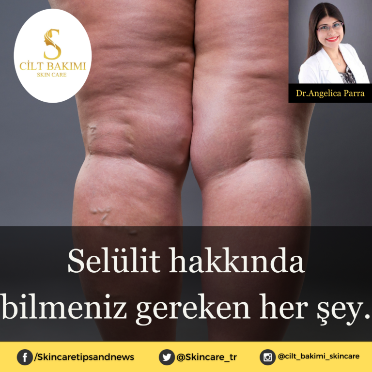Selülit hakkında bilmeniz gereken her şey.