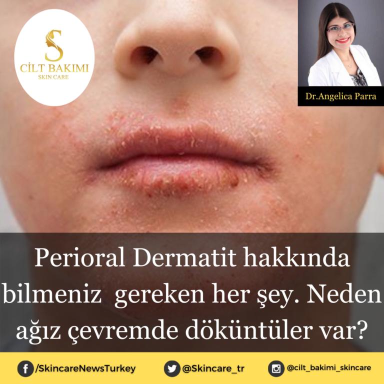 Perioral Dermatit hakkında bilmeniz  gereken her şey. Neden ağız çevremde döküntüler var?