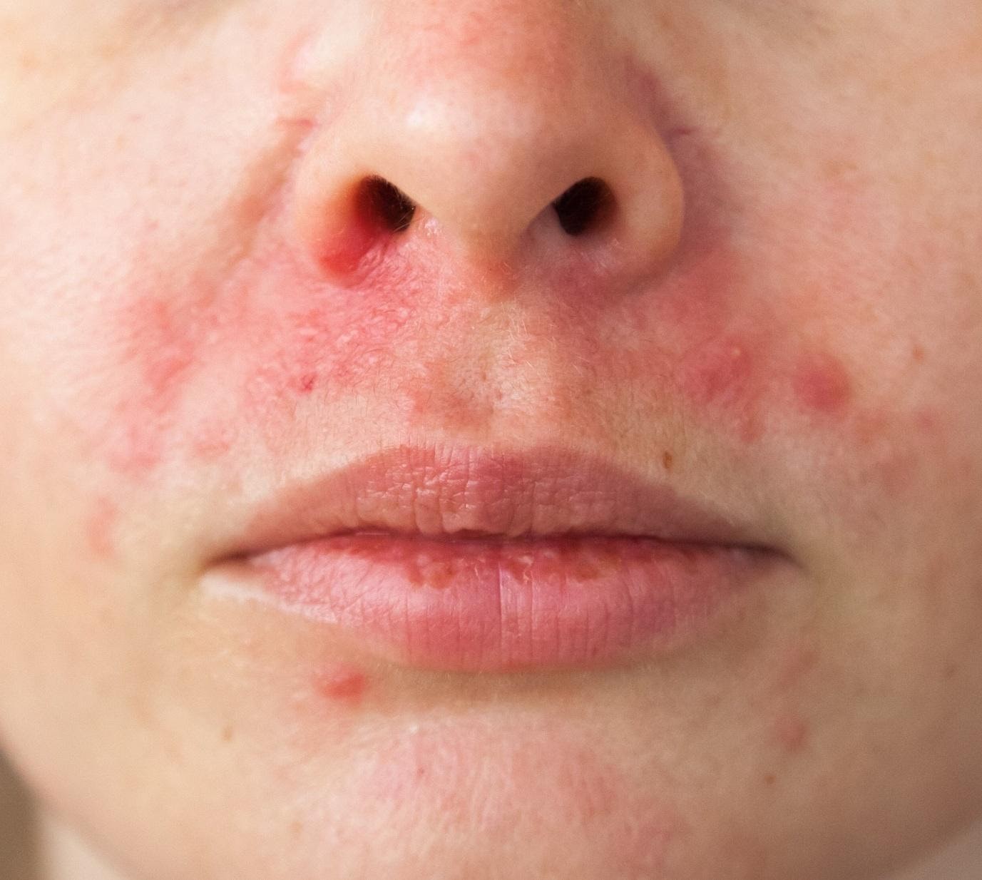 Perioral Dermatit