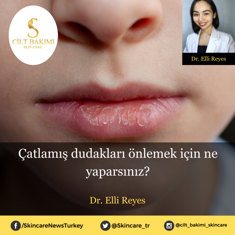 Çatlamış dudak önlemek için ne yaparsınız?