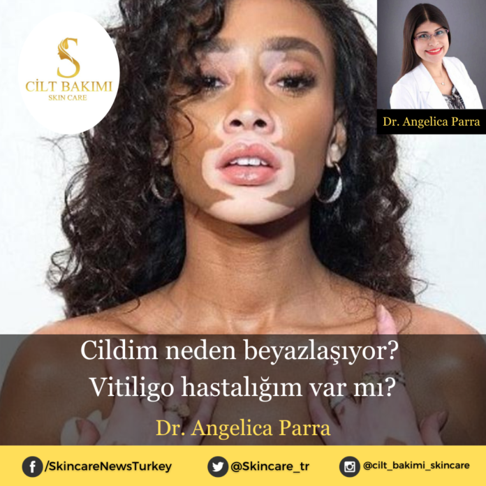 Skincare News v2 - Haziran Kopyası (5) vitiligo