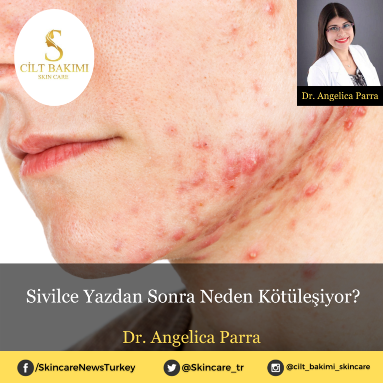 Sivilce Yazdan Sonra Neden Kötüleşiyor?