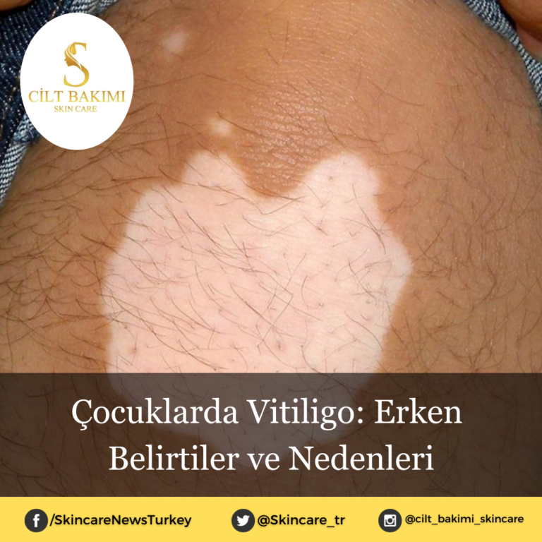 Çocuklarda Vitiligo: Erken Belirtiler ve Nedenleri