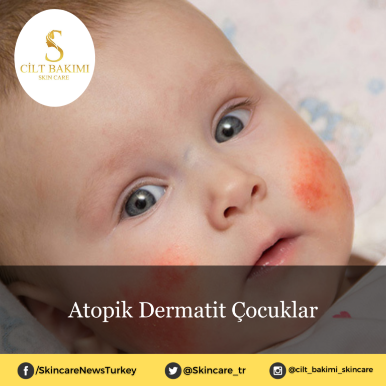Atopik Dermatit Çocuklar