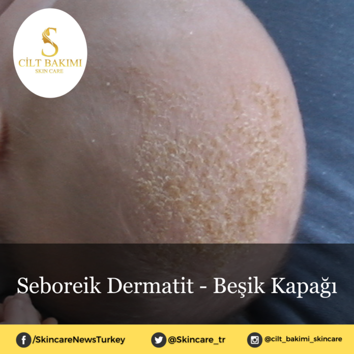Skincare News v2 - Haziran Kopyası Kopyası (1) seboreik