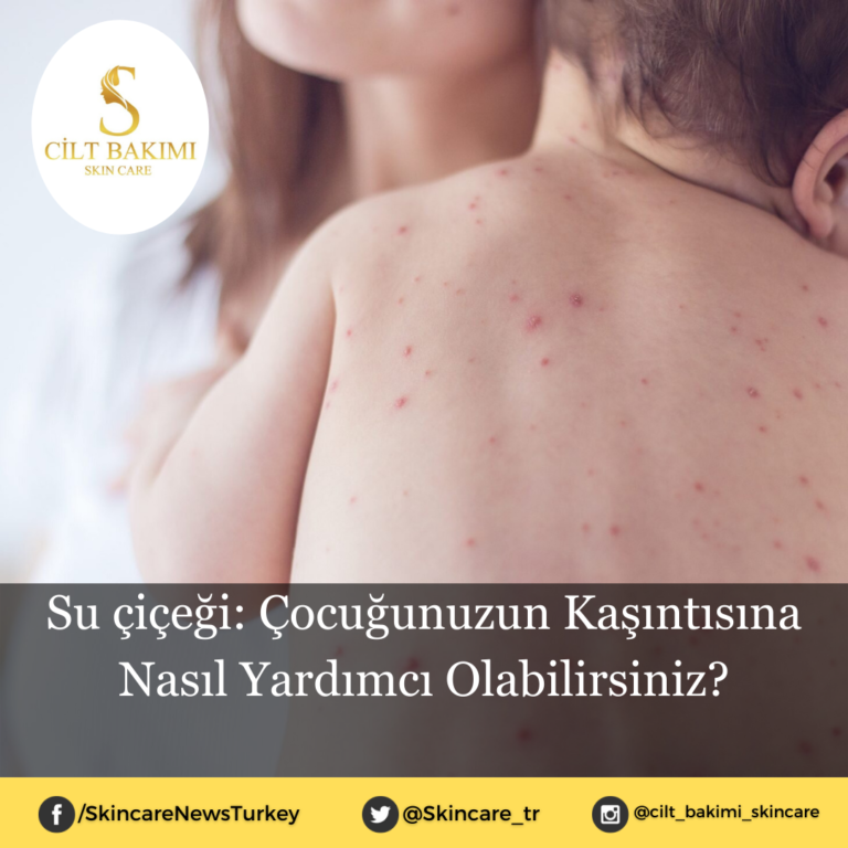 Su çiçeği: Çocuğunuzun Kaşıntısına Nasıl Yardımcı Olabilirsiniz?