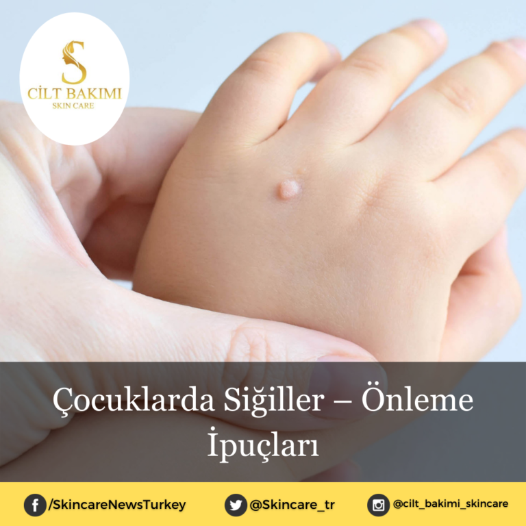 Çocuklarda Siğiller – Önleme İpuçları