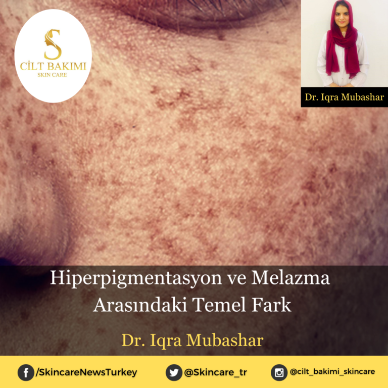 Hiperpigmentasyon ve Melazma Arasındaki Temel Fark