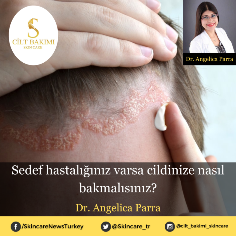 Sedef hastalığınız varsa cildinize nasıl bakmalısınız?