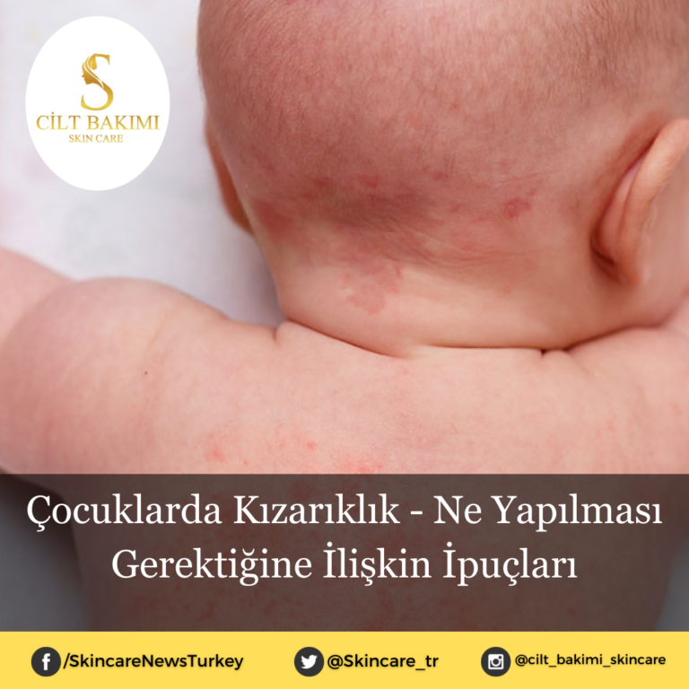 Çocuklarda Kızarıklık – Ne Yapılması Gerektiğine İlişkin İpuçları