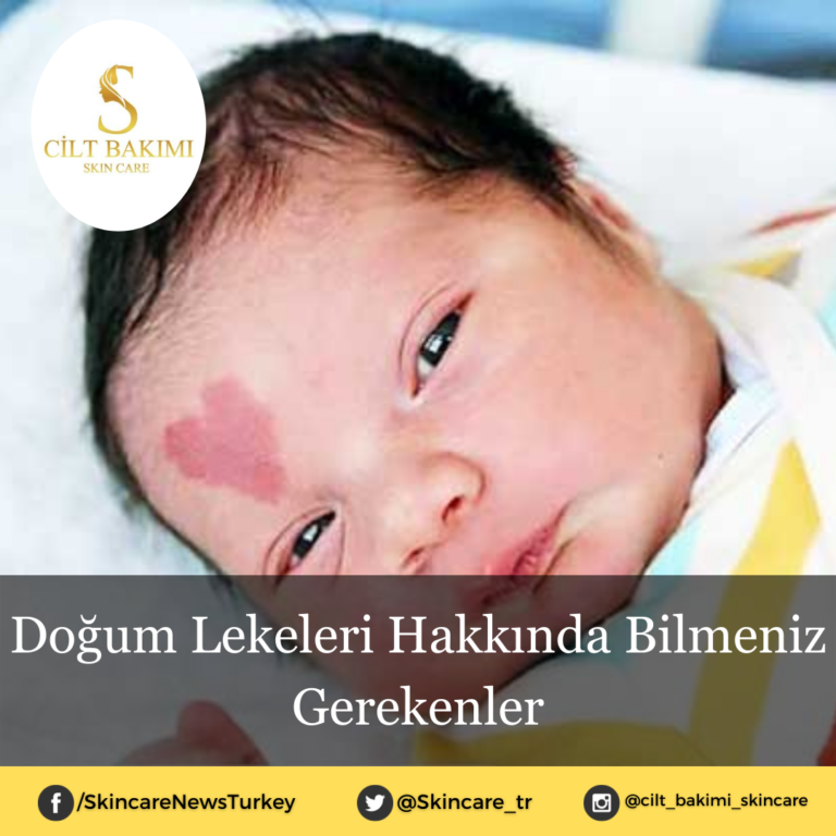 Doğum Lekeleri Hakkında Bilmeniz Gerekenler