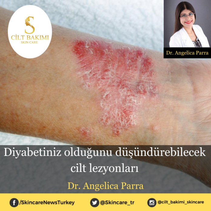 Diyabetiniz