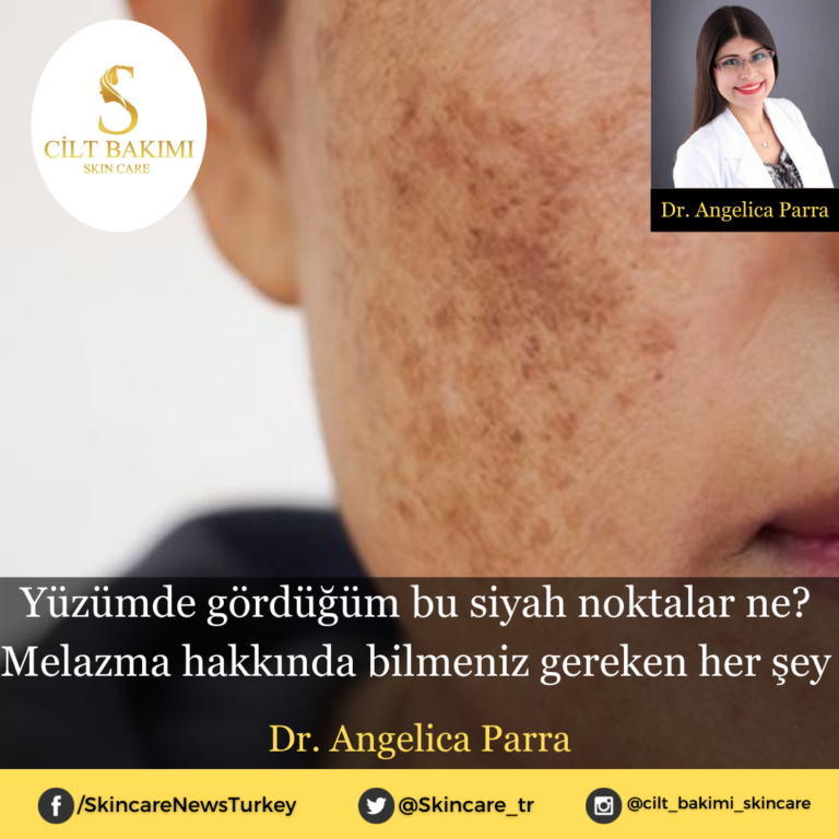Yüzümde gördüğüm bu siyah noktalar ne? Melazma hakkında bilmeniz gereken her şey