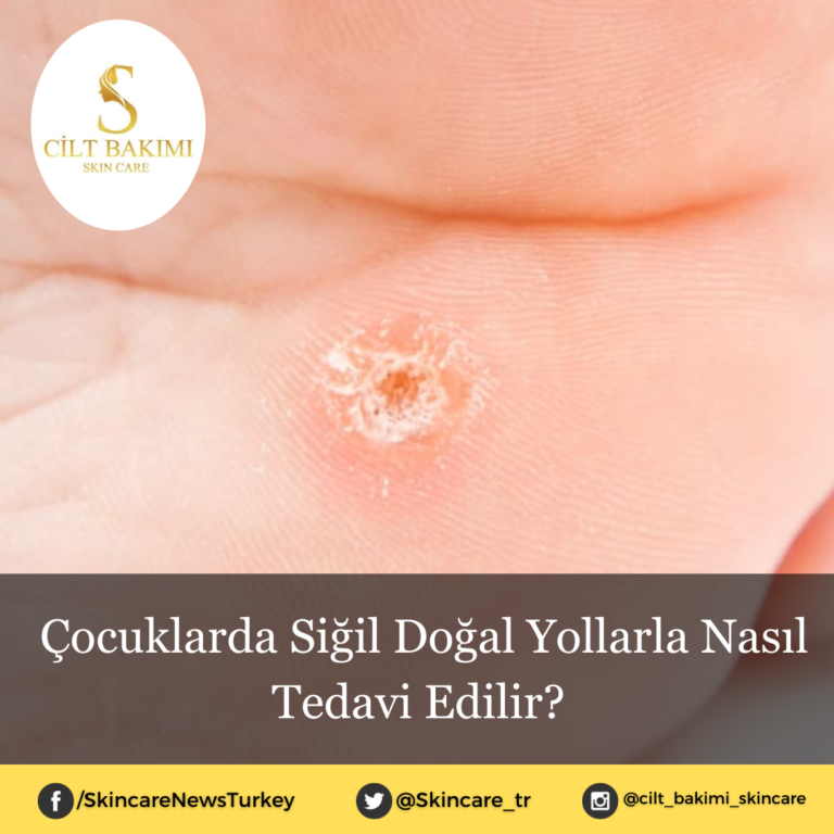 Çocuklarda Siğil Doğal Yollarla Nasıl Tedavi Edilir?