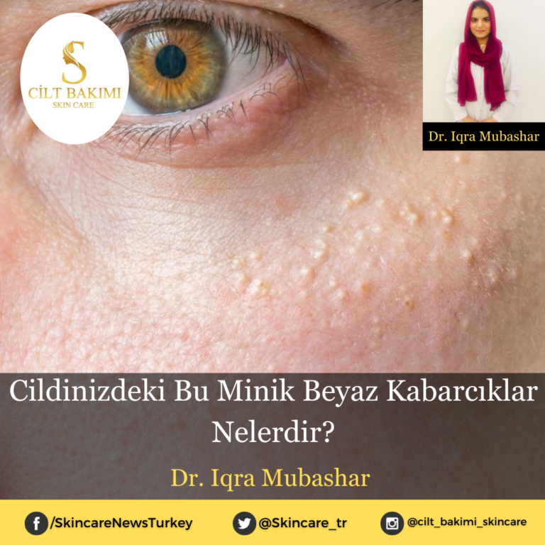 Cildinizdeki Bu Minik Beyaz Kabarcıklar Nelerdir?