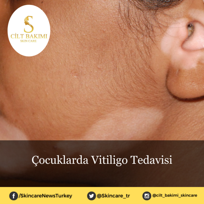 Skincare News v2 - Haziran Kopyası Kopyası (2) çocuklarda vitiligo