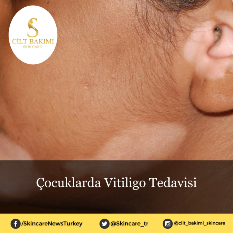 Çocuklarda Vitiligo Tedavisi