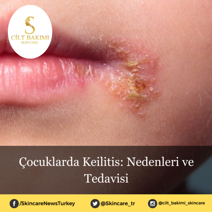 Skincare News v2 - Haziran Kopyası Kopyası (3) Çocuklarda