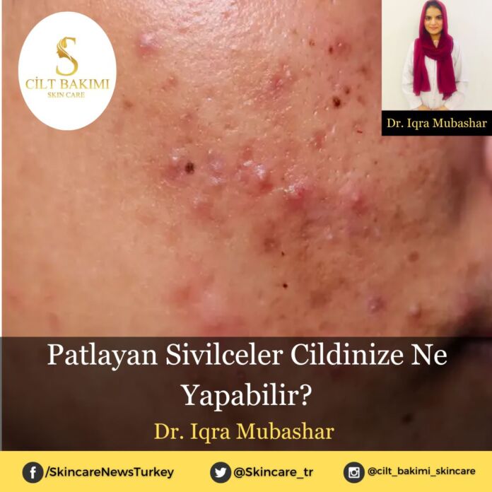 Patlayan Sivilceler Cildinize Ne Yapabilir?