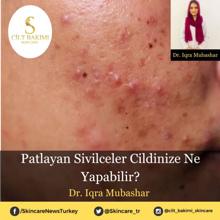 Patlayan Sivilceler Cildinize Ne Yapabilir?