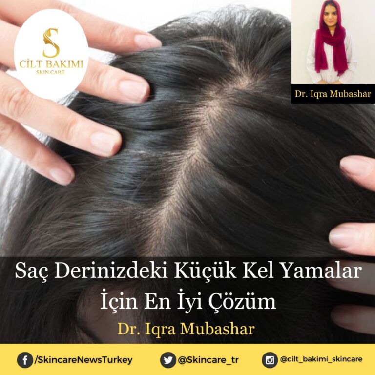 Saç Derinizdeki Küçük Kel Yamalar İçin En İyi Çözüm