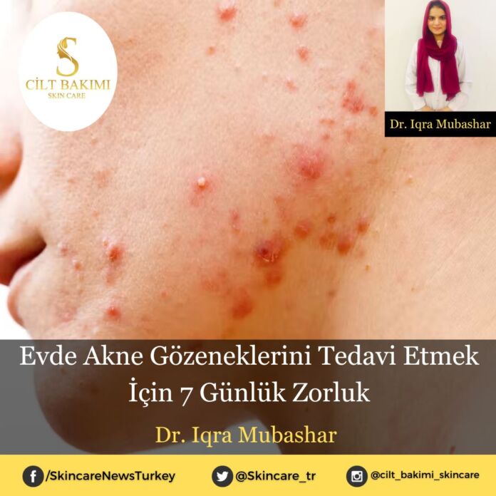 Skincare News v2 - Haziran Kopyası (2) Evde Akne Gözeneklerini Tedavi Etmek İçin 7 Günlük Zorluk