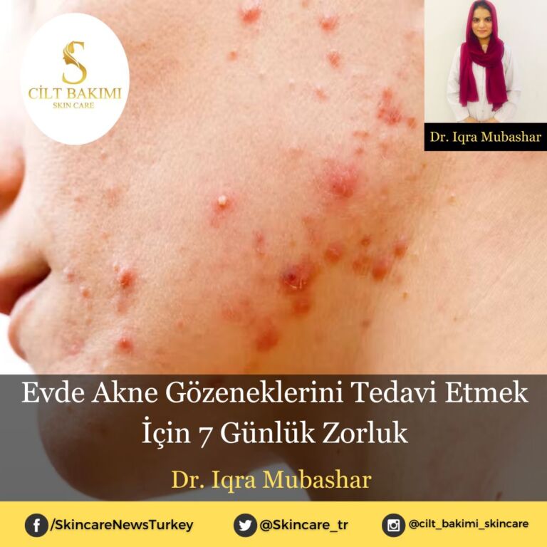 Evde Akne Gözeneklerini Tedavi Etmek İçin 7 Günlük Zorluk