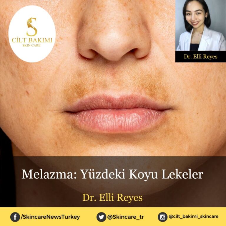 Melazma: Yüzdeki Koyu Lekeler