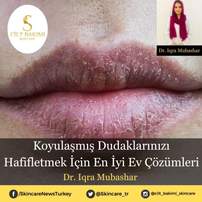 Skincare News v2 - Haziran Kopyası (4) Koyulaşmış Dudaklarınızı Hafifletmek İçin En İyi Ev Çözümleri