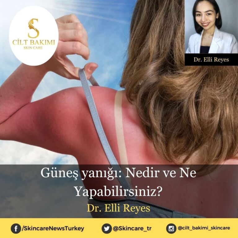 Güneş yanığı: Nedir ve Ne Yapabilirsiniz?