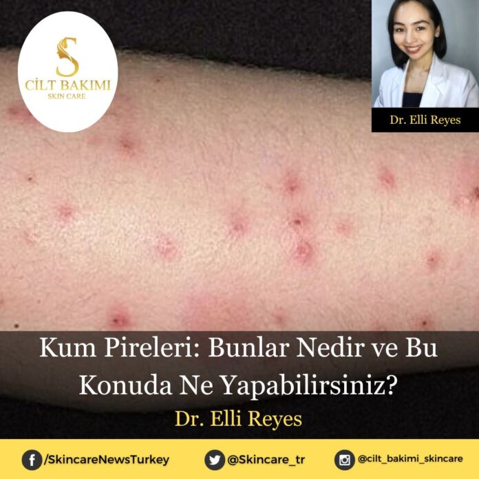 Kum Pireleri: Bunlar Nedir ve Bu Konuda Ne Yapabilirsiniz?